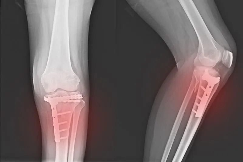 Curación de osteomielitis